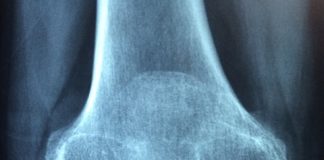 Odczynowe zapalenie stawów